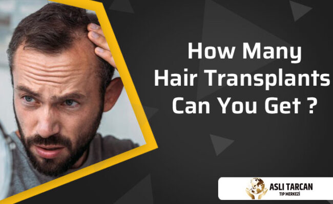 how-many-hair-transplants-can-you-get